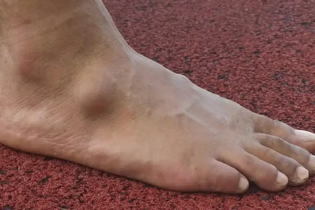 Ganglion cyst treatment