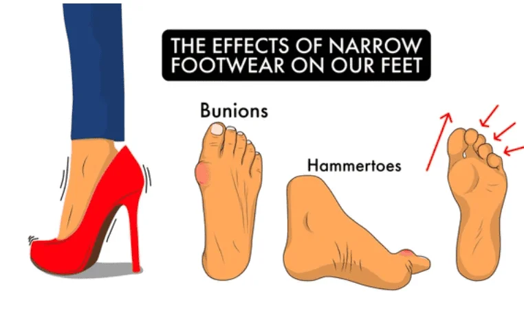 Bunion diagram