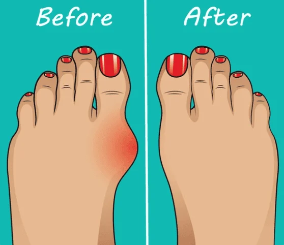 Illustration comparing a foot before and after bunion correction