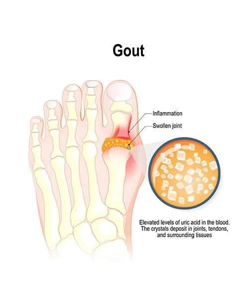 Gout treatment