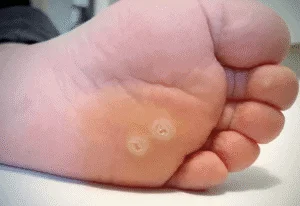 Unmasking Warts: A Podiatrist’s and Dermatologist’s Guide to Treatment and Prevention