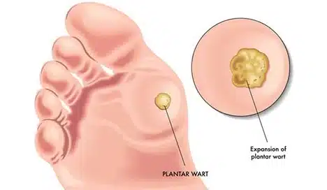 Plantar wart treatment