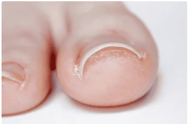 Ingrown toenail treatment