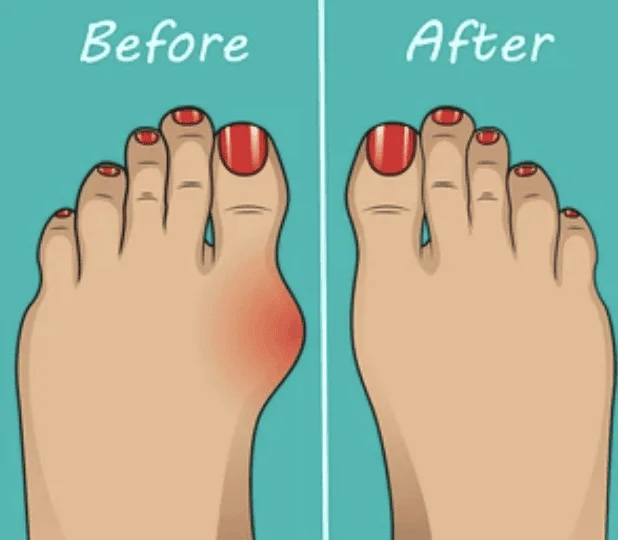 Bunion correction before and after