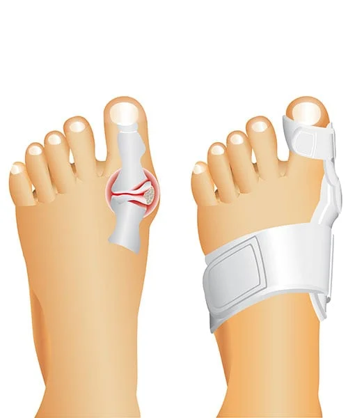 Turf toe support
