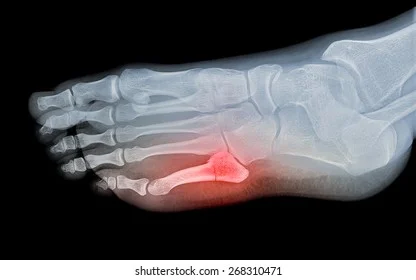 X-ray of a metatarsal fracture