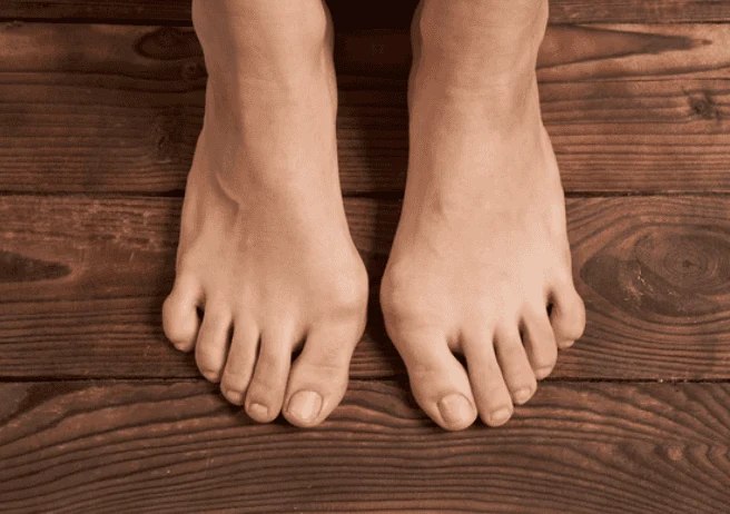 5 Warning Signs Your Bunion Symptoms Are Worsening in Bridgewater, NJ